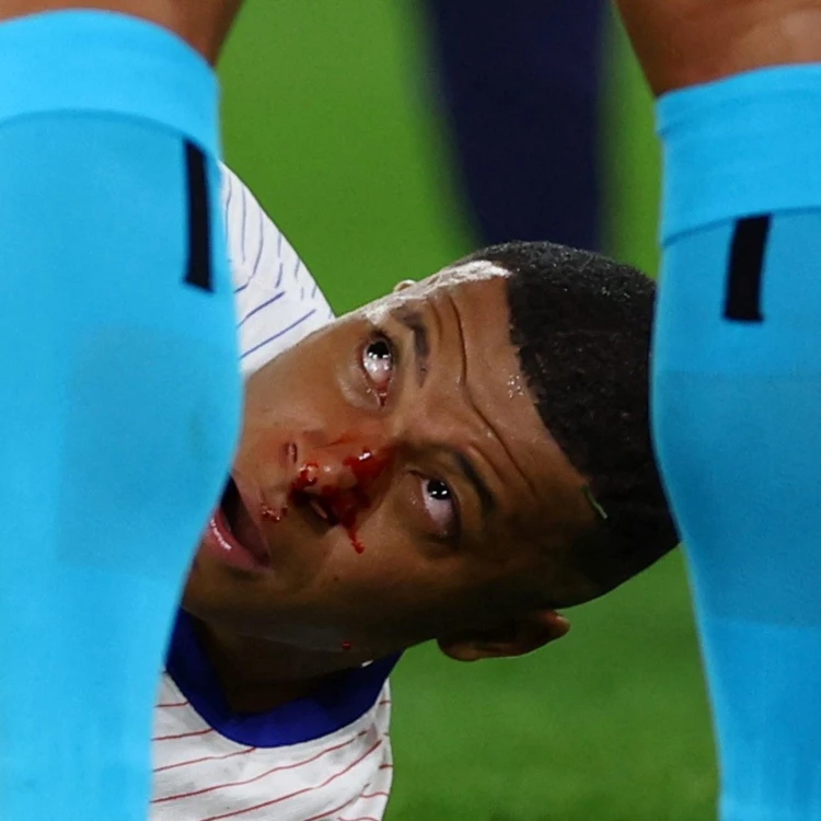 Imagen relacionada de preocupacion por la lesion de mbappe en la eurocopa 2024